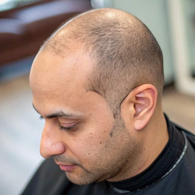 Man with a clean-shaven head and sharply defined hairline showing an even, low-contrast finish.